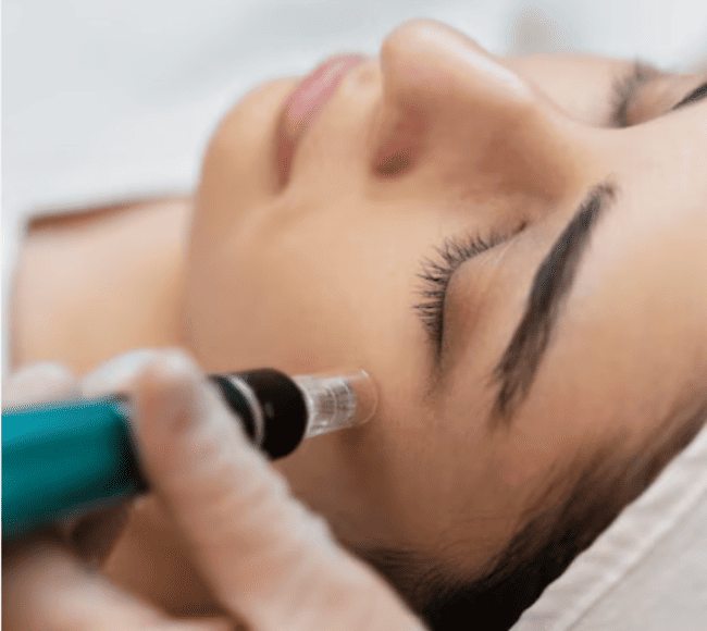Microneedling
