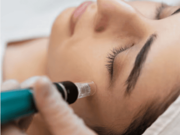 Microneedling